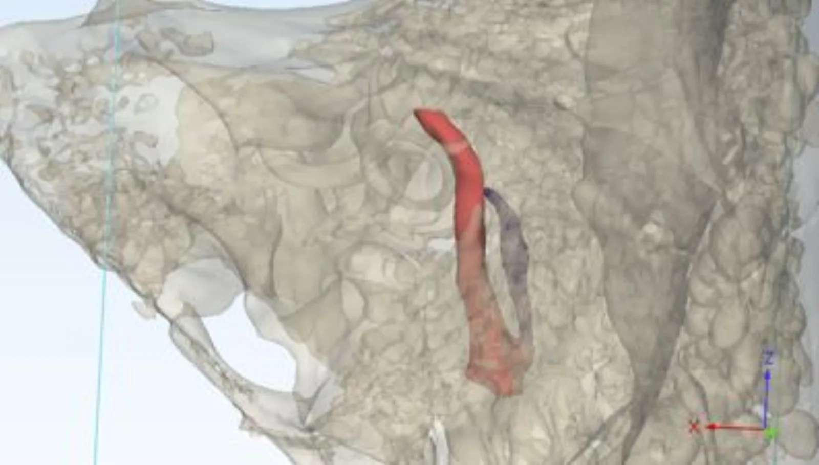Lateral view of cholesteatoma pathway