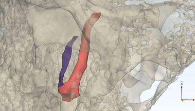 3D nasal anatomy with highlighted pathology