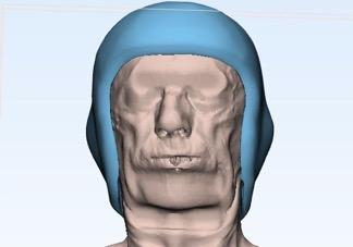 3D model showing bolus placement on face