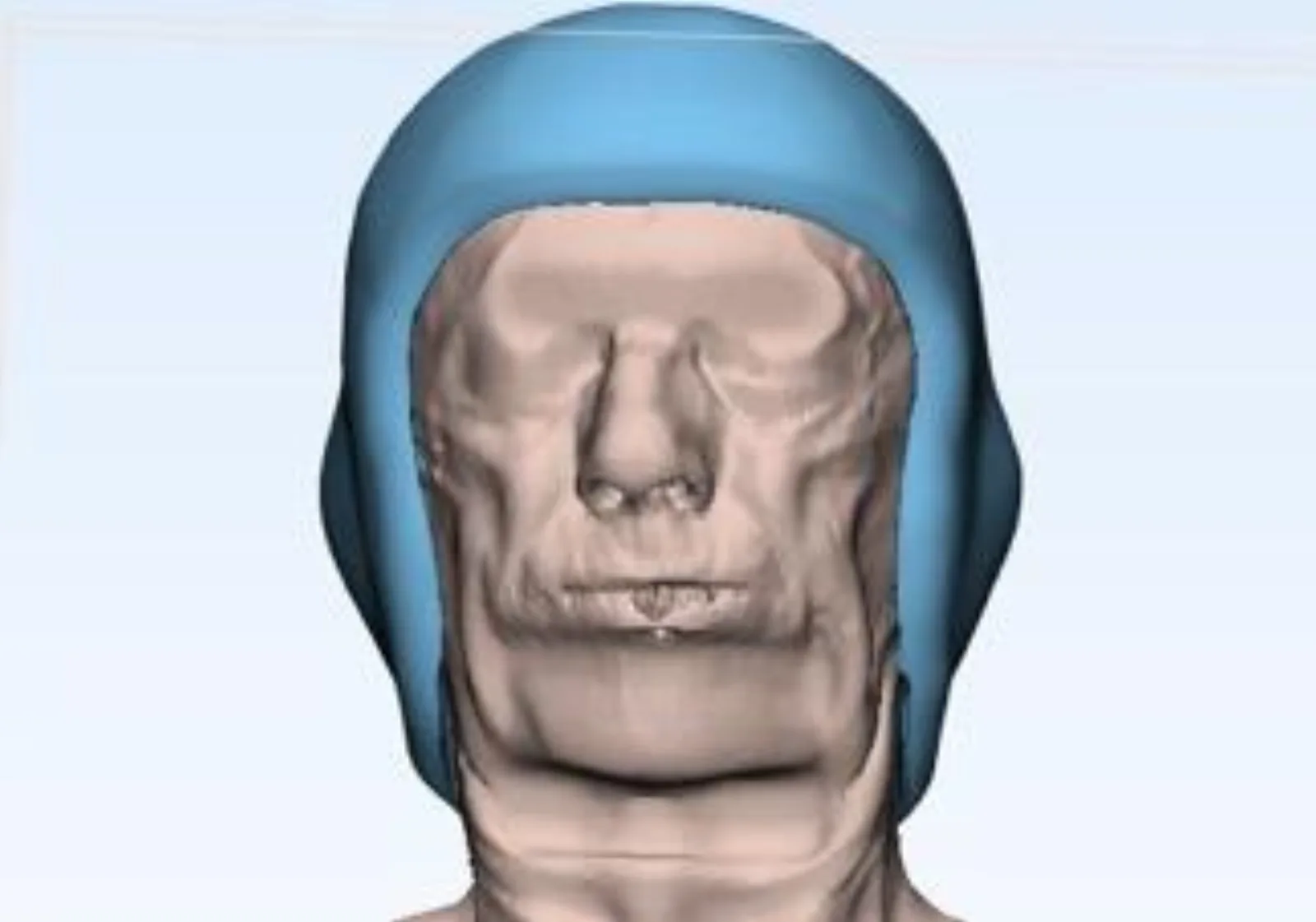 3D model showing bolus placement on face